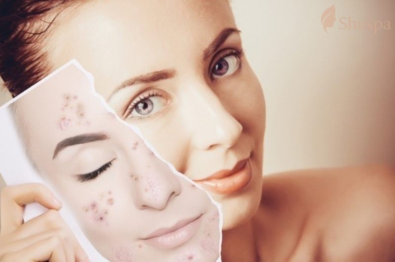 Điều trị mụn nhỏ liti trên mặt bằng phương pháp hóa học giúp tăng quá trình tái tạo da