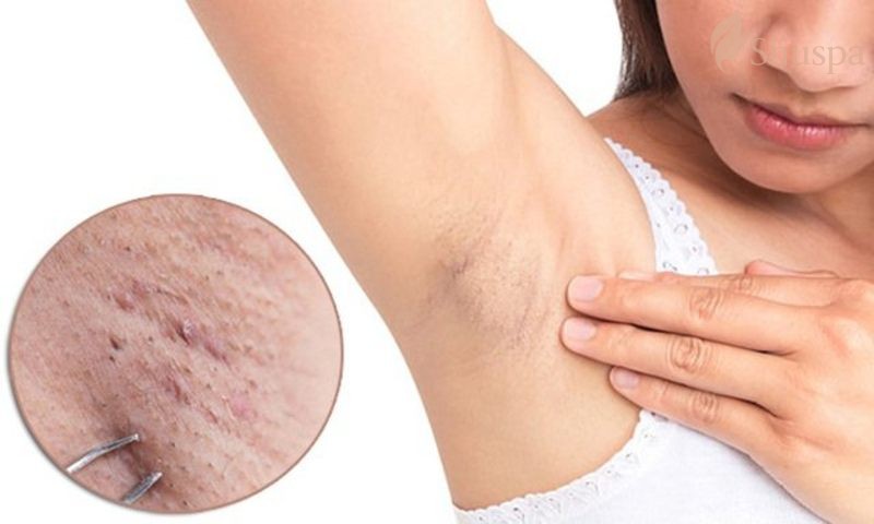 Sử dụng nhíp để nhổ lông nách tuy tiết kiệm chi phí nhưng sẽ dễ gây ra viêm nang lông 