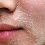 Peel da là làm gì? Đây là quá trình loại bỏ tế bào chết và tái tạo lại làn da