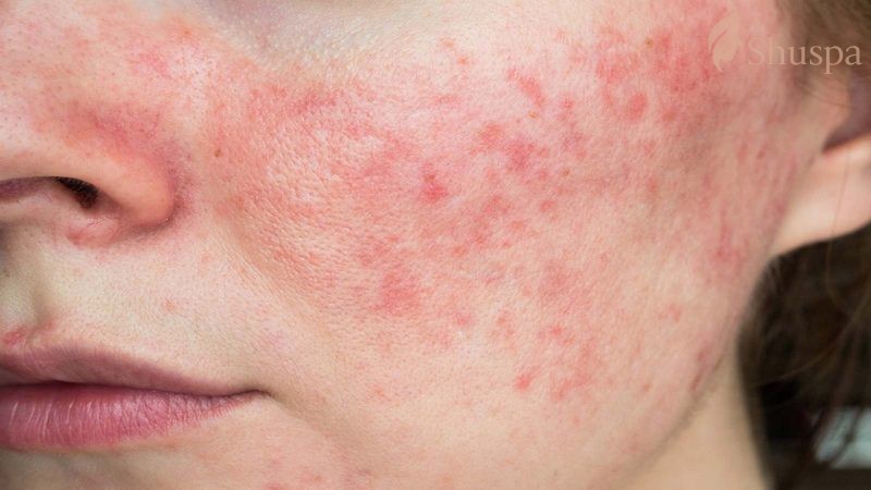 Đỏ da, kích ứng là một trong những dấu hiệu phổ biến trong tác dụng phụ khi sử dụng kem trị mụn viêm