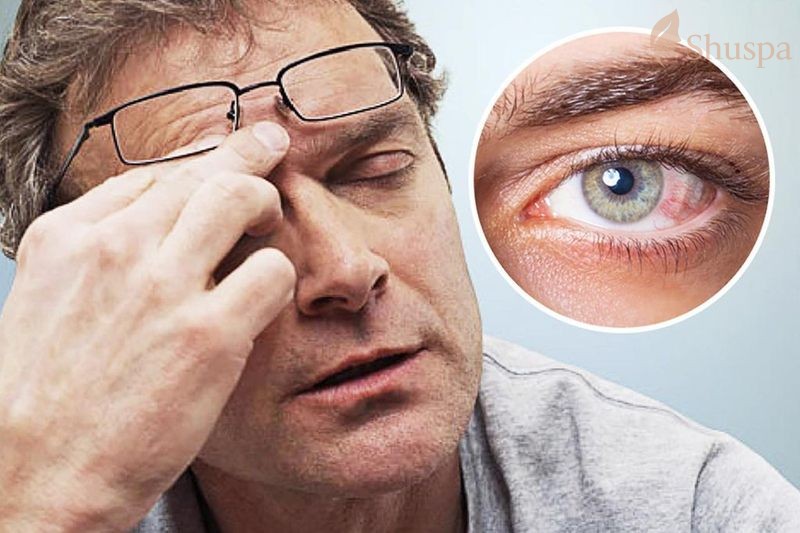 Giật lông mày trái cũng có thể là nguyên nhân về các tình trạng mắt