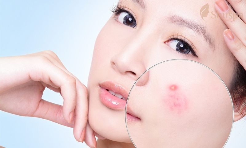 Lấy nhân mụn cho da khổ và da nhạy cảm cần được chăm sóc đặc biệt