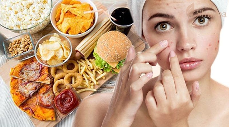 Cần có chế độ ăn phù hợp khi điều trị mụn viêm