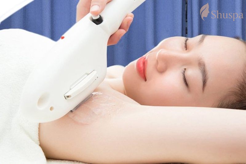 Triệt lông diode laser rất được ưa chuộng nhưng sẽ chỉ phù hợp với một số đối tượng