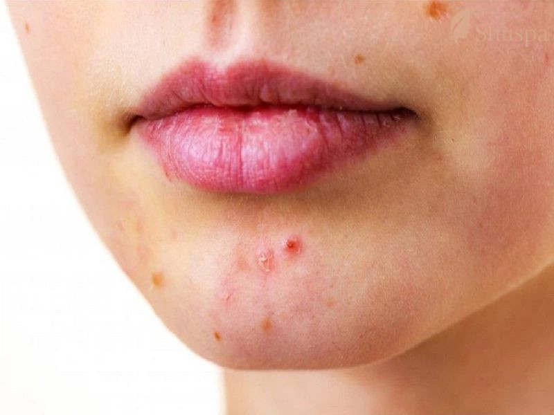 Lối sống và chế độ dinh dưỡng phù hợp sẽ giúp ngăn ngừa mụn bọc