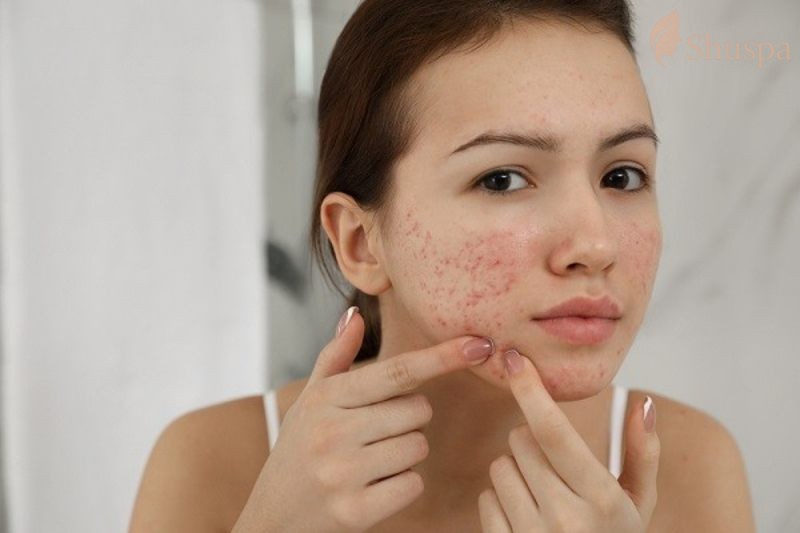 Một số phương pháp trị thâm hiệu quả từ cao bí đao