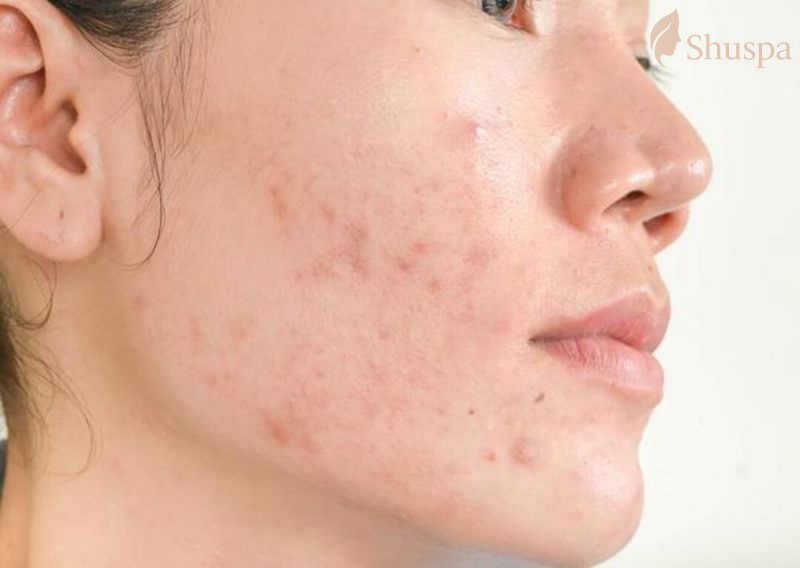 Thời gian cải thiện thâm mụn sẽ phụ thuộc vào tình trạng da của bạn