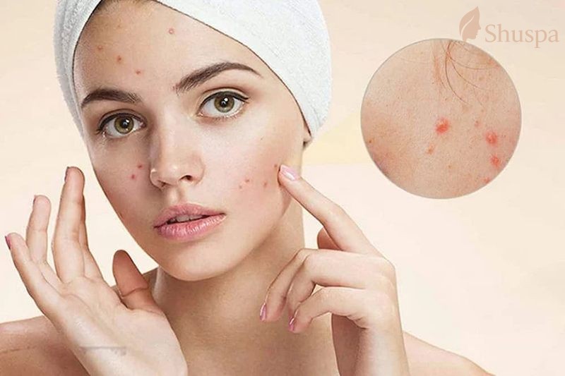 Làn da yếu và nhạy cảm sau nặn mụn cần có quy trình chăm sóc phù hợp