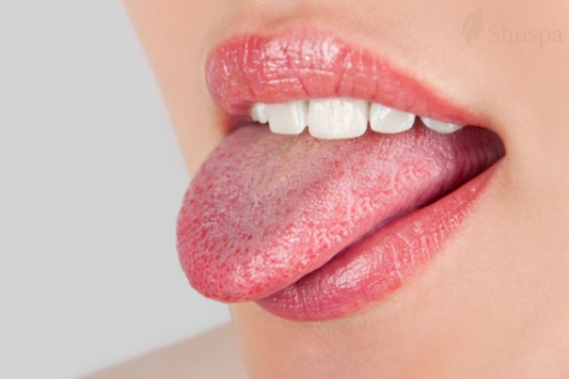 Nốt sần lưỡi là tình trạng các nhú vị giác trên lưỡi bị sưng to và nổi các nốt sần
