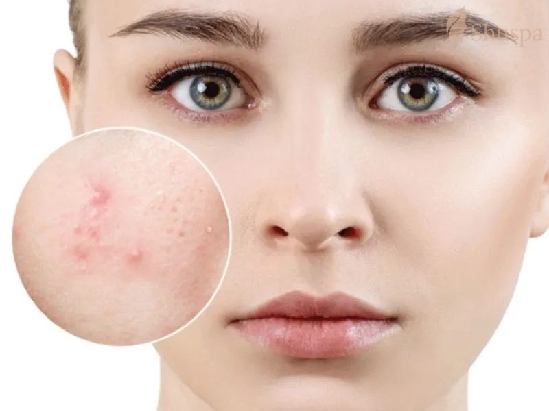 Một số sản phẩm sẽ giúp chăm sóc da sau nặn mụn tối ưu nhất