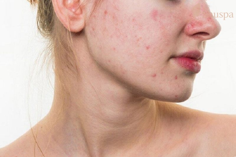 Làn da dầu mụn của bạn sẽ cần có một quá trình dưỡng ẩm phù hợp và hiệu quả