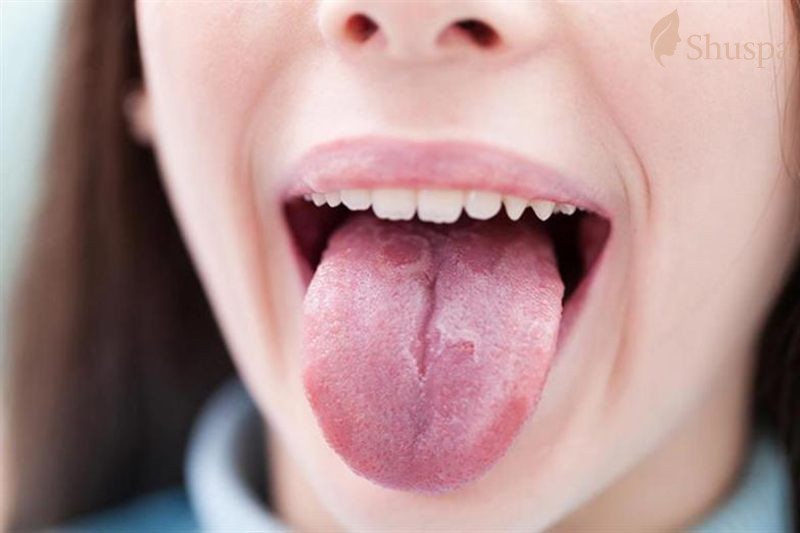 Các triệu chứng mụn ở lưỡi mà mọi người cần quan tâm để điều trị đúng cách