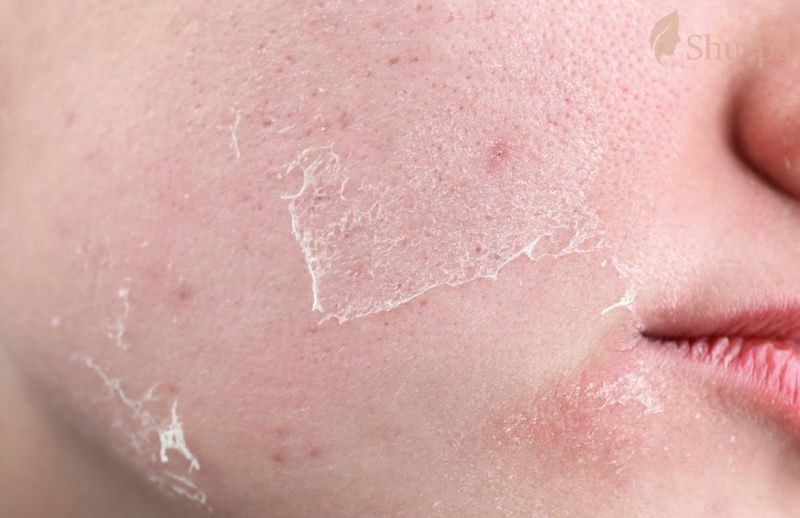 Những giai đoạn phục hồi sau peel da mà bạn nên quan tâm