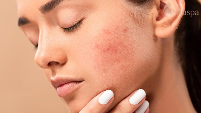 Quy trình dưỡng ẩm là một yếu tố cần chú ý trong việc chăm sóc làn da nhạy cảm của bạn