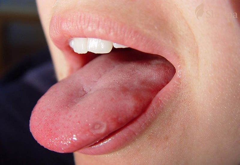 Bạn cần kiểm tra mức độ nghiêm trọng của mụn ở lưỡi của mình