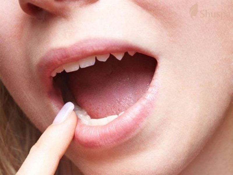 Một số lưu ý giúp phòng tránh mụn ở lưỡi cho mọi người tham khảo