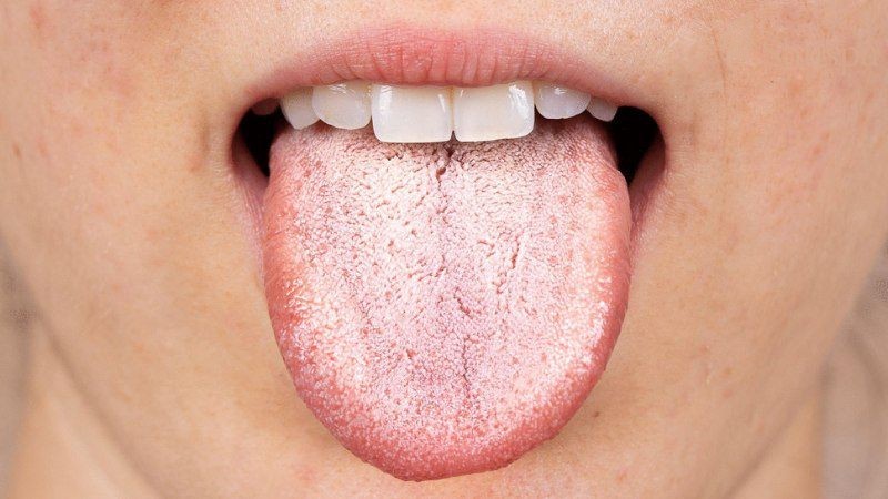 Một số bệnh lý liên quan đến mụn ở lưỡi